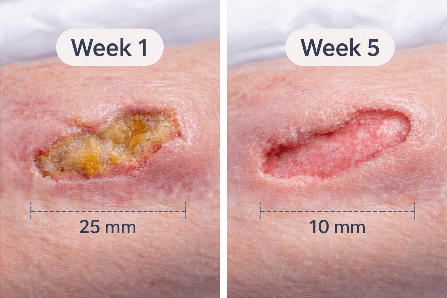 Complex wound clinical case comparing wound progression with structured medical capture